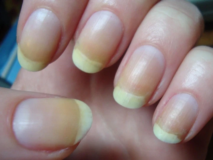 Yellow Nails